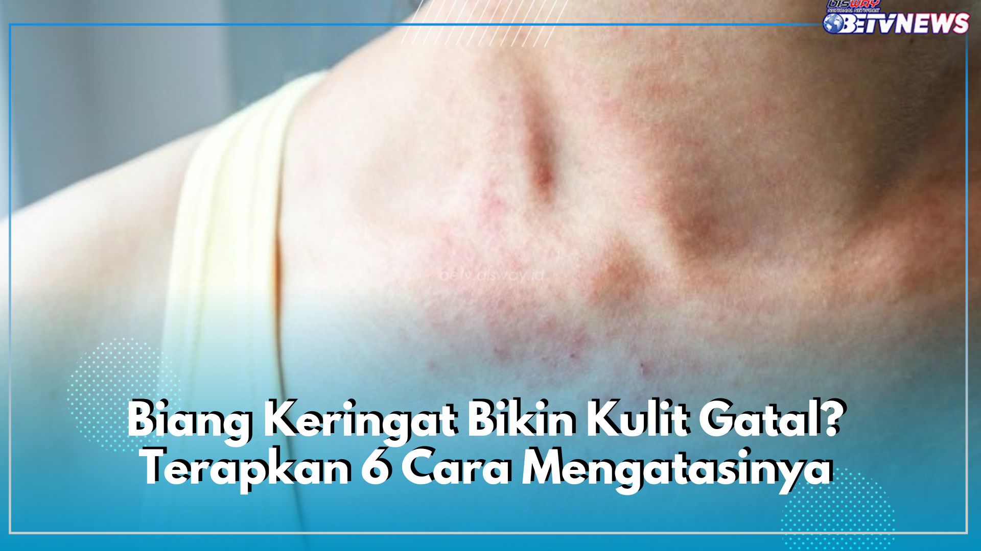 Biang Keringat Bikin Kulit Gatal? Terapkan 6 Cara Mengatasinya Berikut Ini