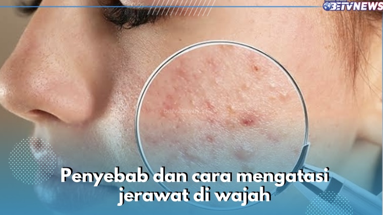 Bakteri Menjadi Salah Satu Penyebab Jerawat di Wajah, Yuk Atasi dengan Cara Ini