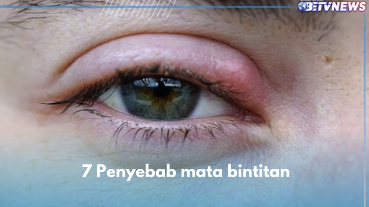 Ini 7 Penyebab Mata Bintitan, Infeksi Akut Kelenjar Minyak hingga Kurang Tidur