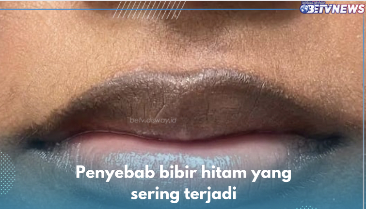 7 Penyebab Bibir Hitam yang Sering Terjadi, Paparan Sinar UV hingga Penggunaan Antibiotik