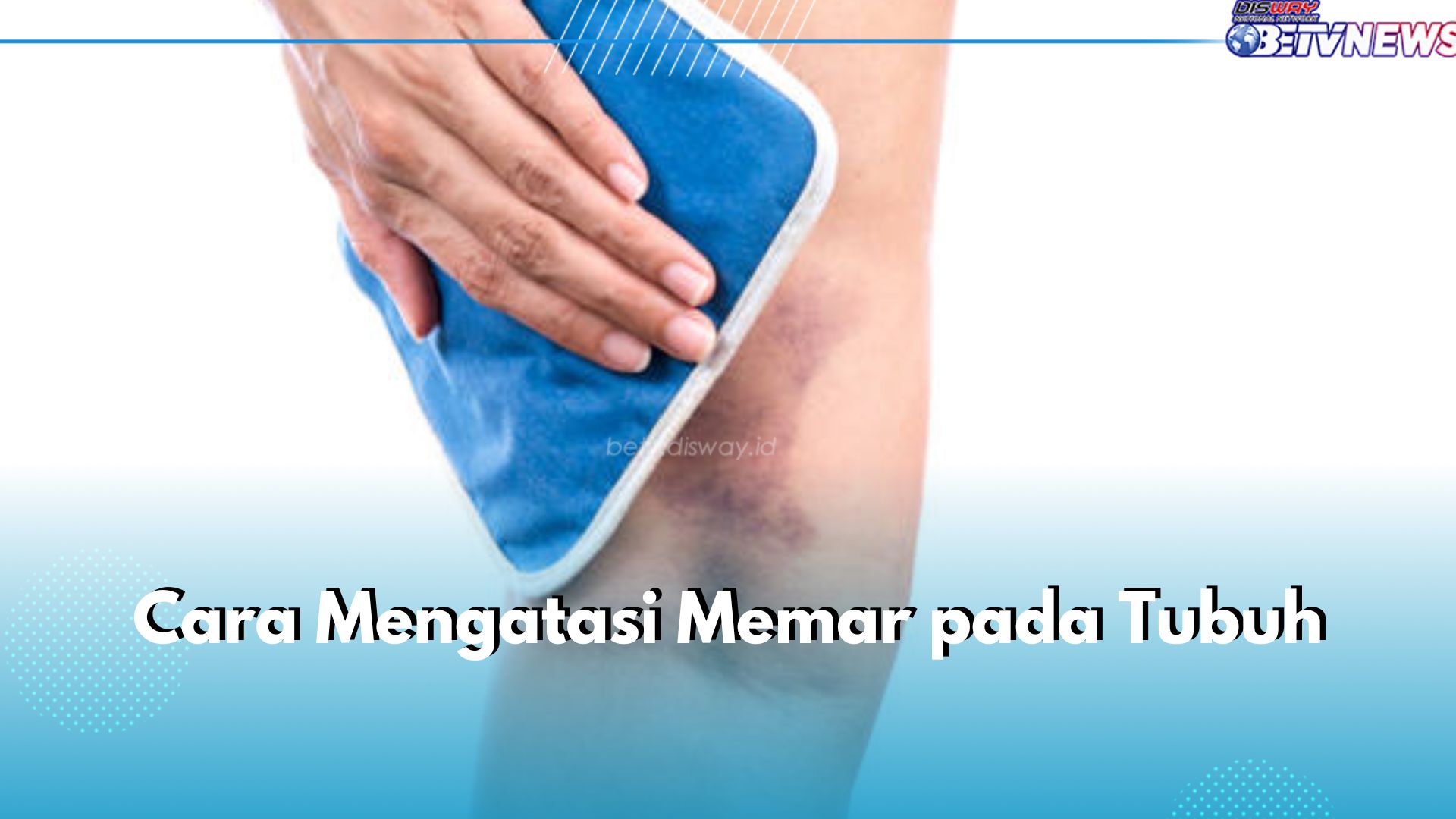 Sering Alami Memar? Gunakan 5 Cara Alami Ini untuk Mengatasinya