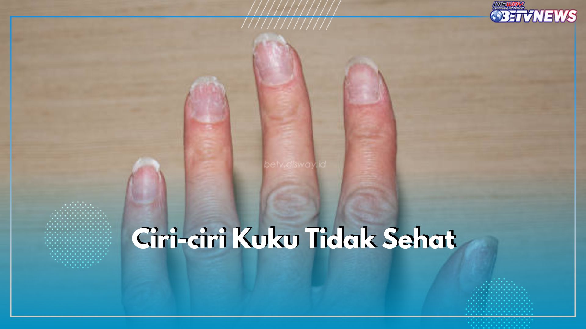 7 Ciri Ini Tunjukkan Jika Kuku Tidak Sehat, Salah Satunya Perubahan Warna Kuku