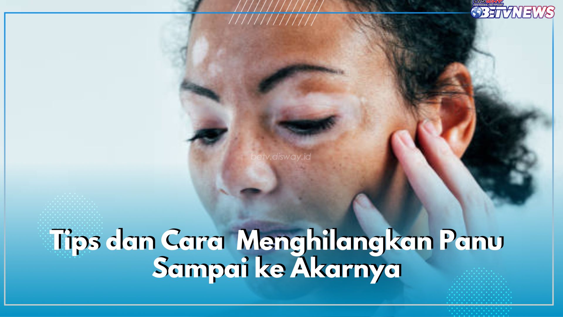 Ini Tips dan Cara Paling Efektif Menghilangkan Panu Sampai ke Akarnya, Dijamin Kulit Mulus Tanpa Bercak