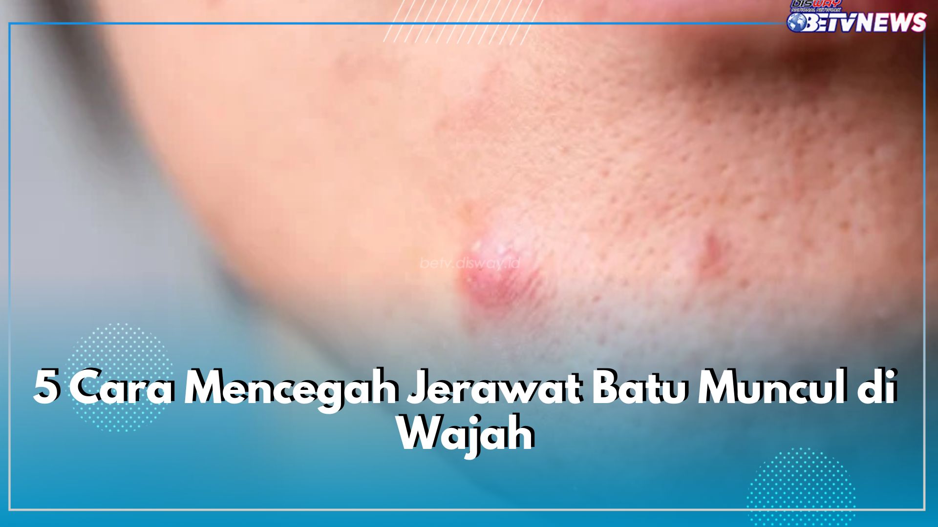 Terapkan Sebelum Terlambat, 5 Cara Mencegah Jerawat Batu Muncul di Wajah, Cek di Sini!