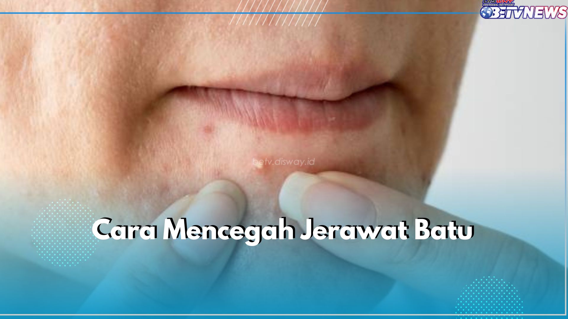 5 Cara Cegah Jerawat Batu di Wajah, Nomor 2 Paling Penting