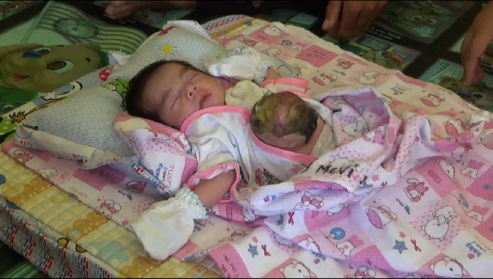 Aisyah Almira, Bayi Dengan Usus Diluar Butuh Uluran Tangan Dermawan