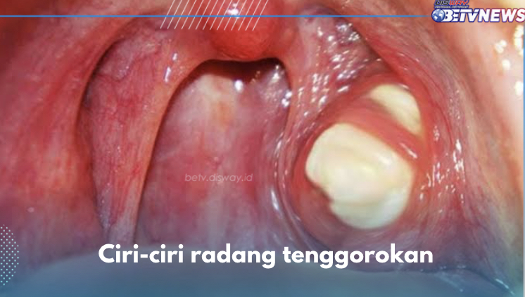 5 Ciri-ciri Radang Tenggorokan, Batuk Termasuk Salah Satunya