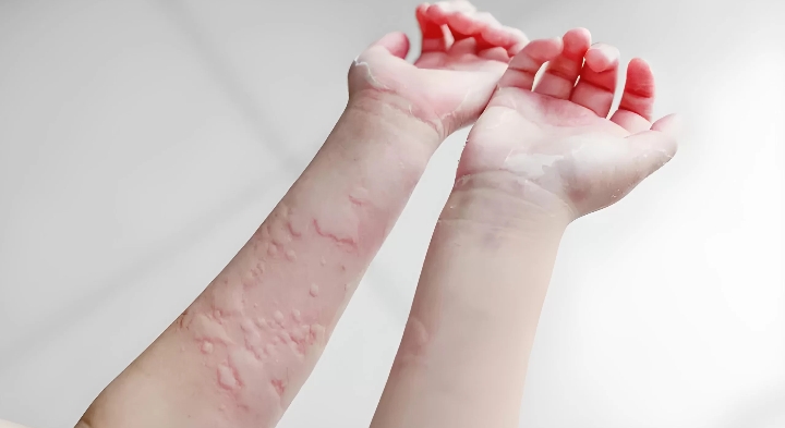 Ada 5 Jenis Obat Herbal yang Dipercaya Ampuh Atasi Biduran