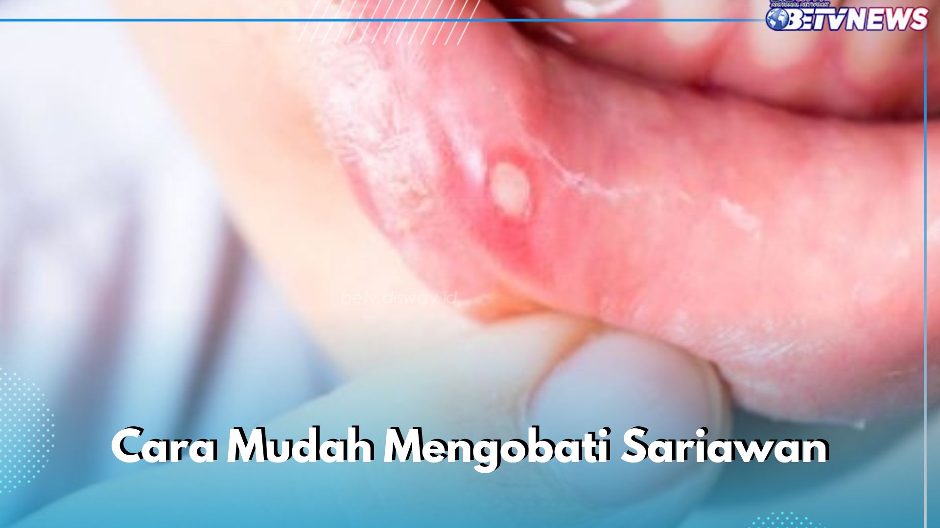 6 Cara Mudah Mengobati Sariawan, Cukup Pakai Rutin Sehari-hari Bahan Alami Ini