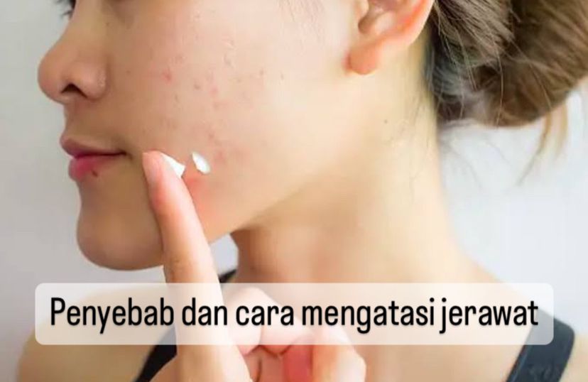 Punya Jerawat di Wajah? Kenali Penyebab dan Cara Mengatasinya di Sini