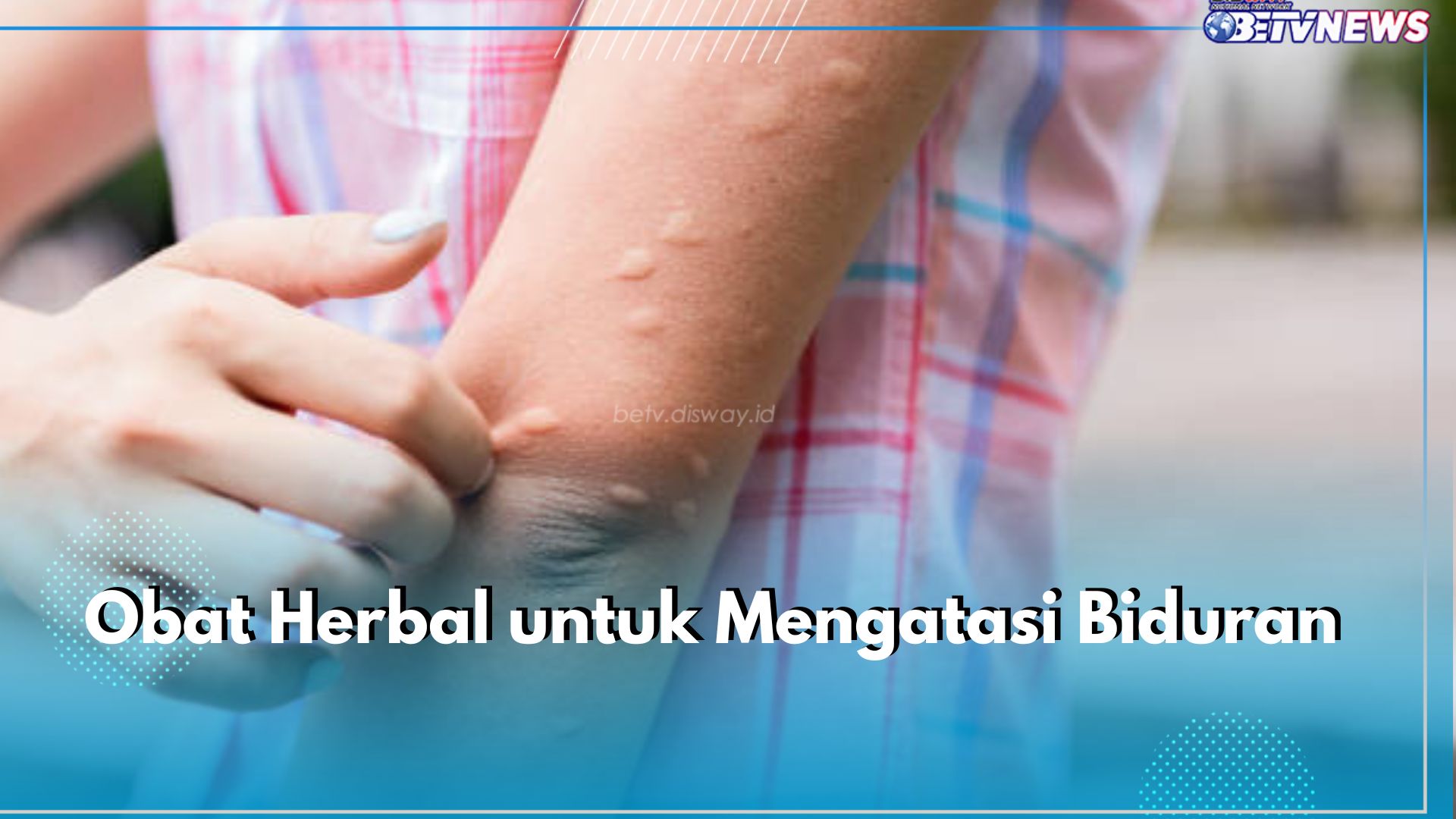 Lidah Buaya hingga Jahe, Ini 5 Jenis Obat Herbal untuk Atasi Biduran Secara Alami