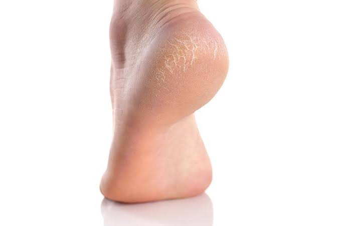 Tumit Kaki Bisa Kering, Ketahui 6 Penyebabnya Berikut Ini, Bisa dari Kebiasaan Sehari-hari