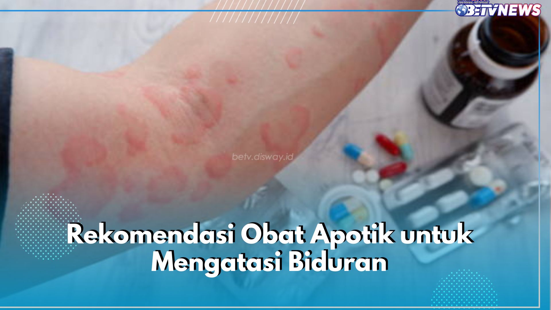 6 Rekomendasi Obat Apotik untuk Atasi Biduran, Salah Satunya Antihistamin