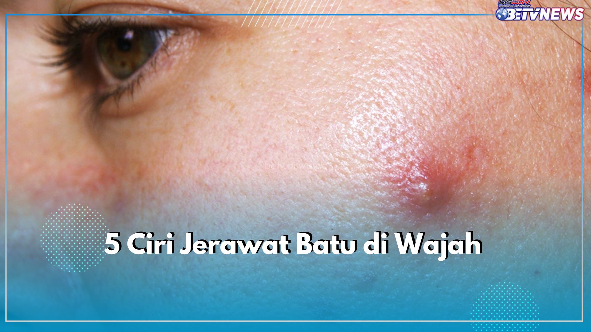 Kenali 5 Ciri Jerawat Batu di Wajah, Salah Satunya Muncul Benjolan Besar, Pernah Alami?