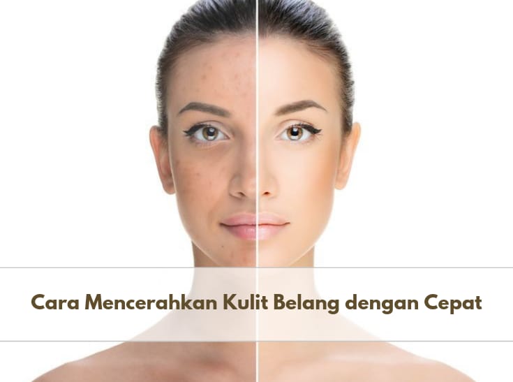 Inilah 5 Cara Ampuh untuk Mencerahkan Kulit Wajah Belang dengan Cepat dan Efektif, Cek Apa Saja