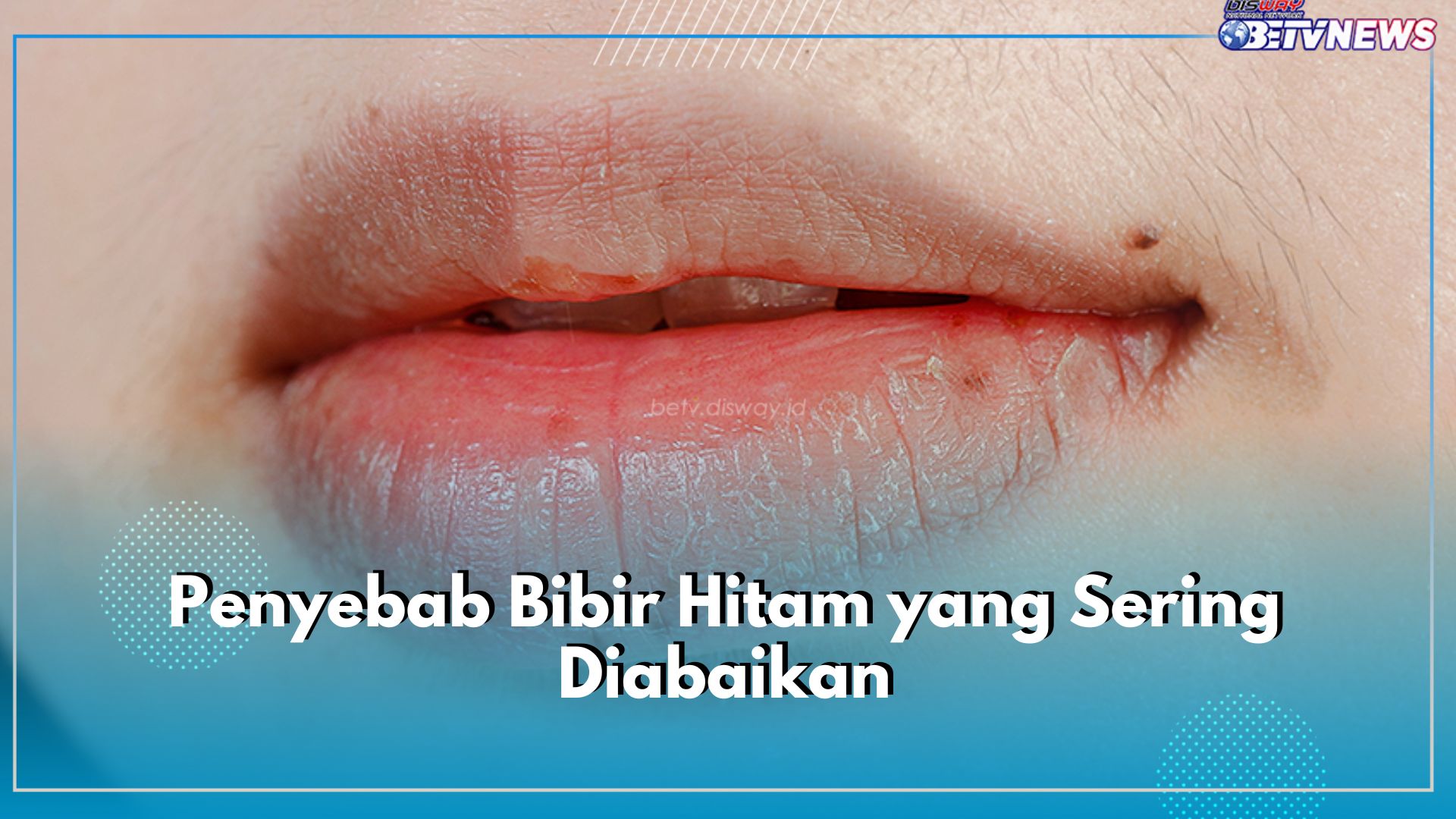 7 Penyebab Bibir Hitam Ini Sering Diabaikan, Yuk Atasi!