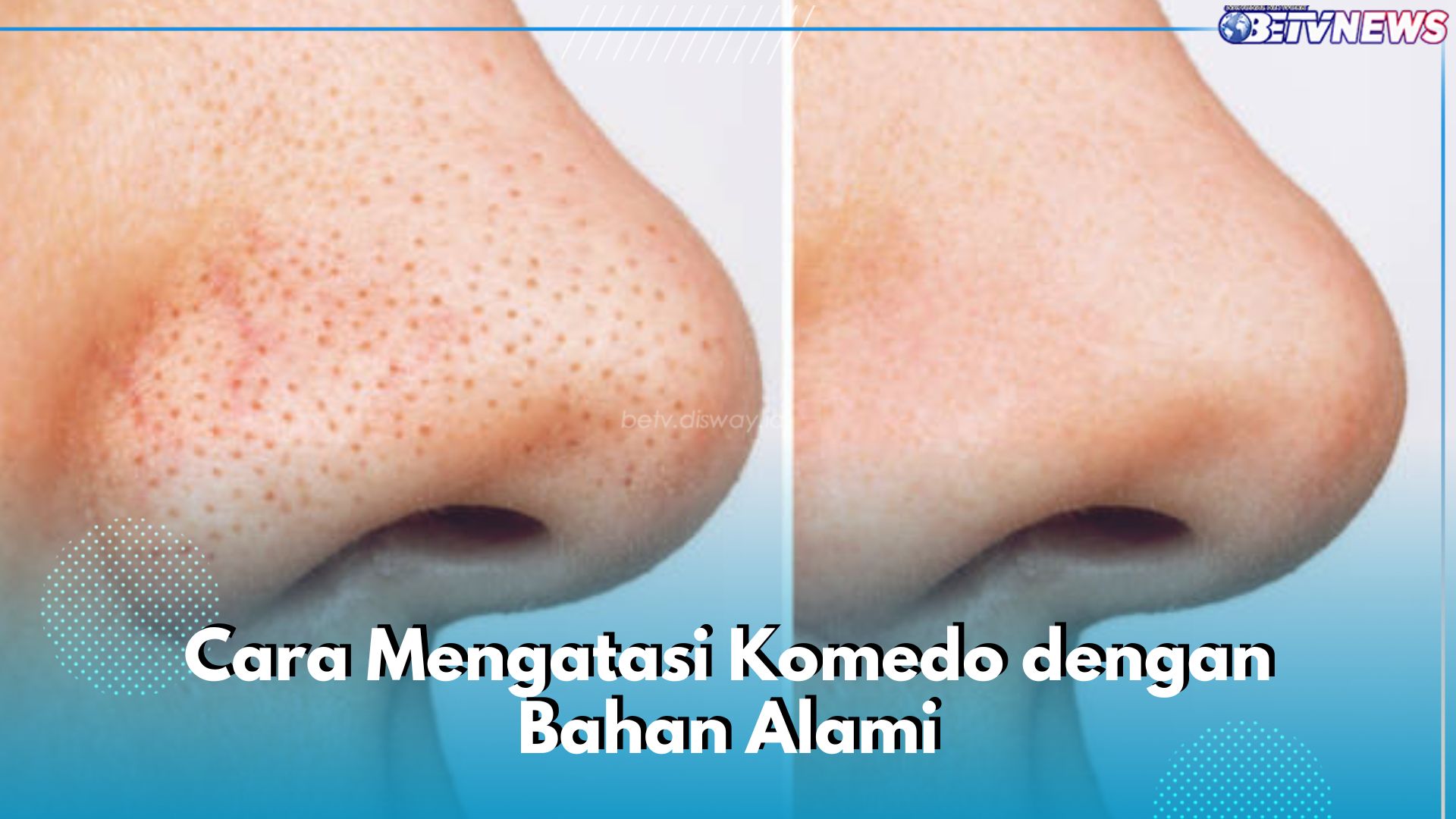 5 Bahan Alami Ini Ampuh Atasi Komedo di Wajah, Salah Satunya Masker Putih Telur