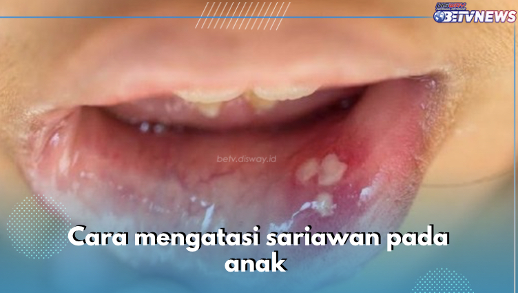 Anak Sariawan? Yuk Atasi dengan 8 Cara Ini, Dijamin Cepat Sembuh