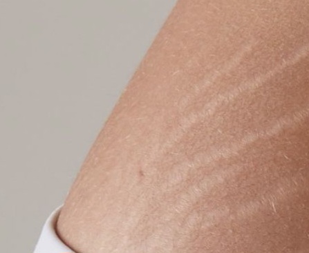 Ini Cara Mengatasi Stretch Mark pada Kulit, Bisa Tampak Lebih Halus