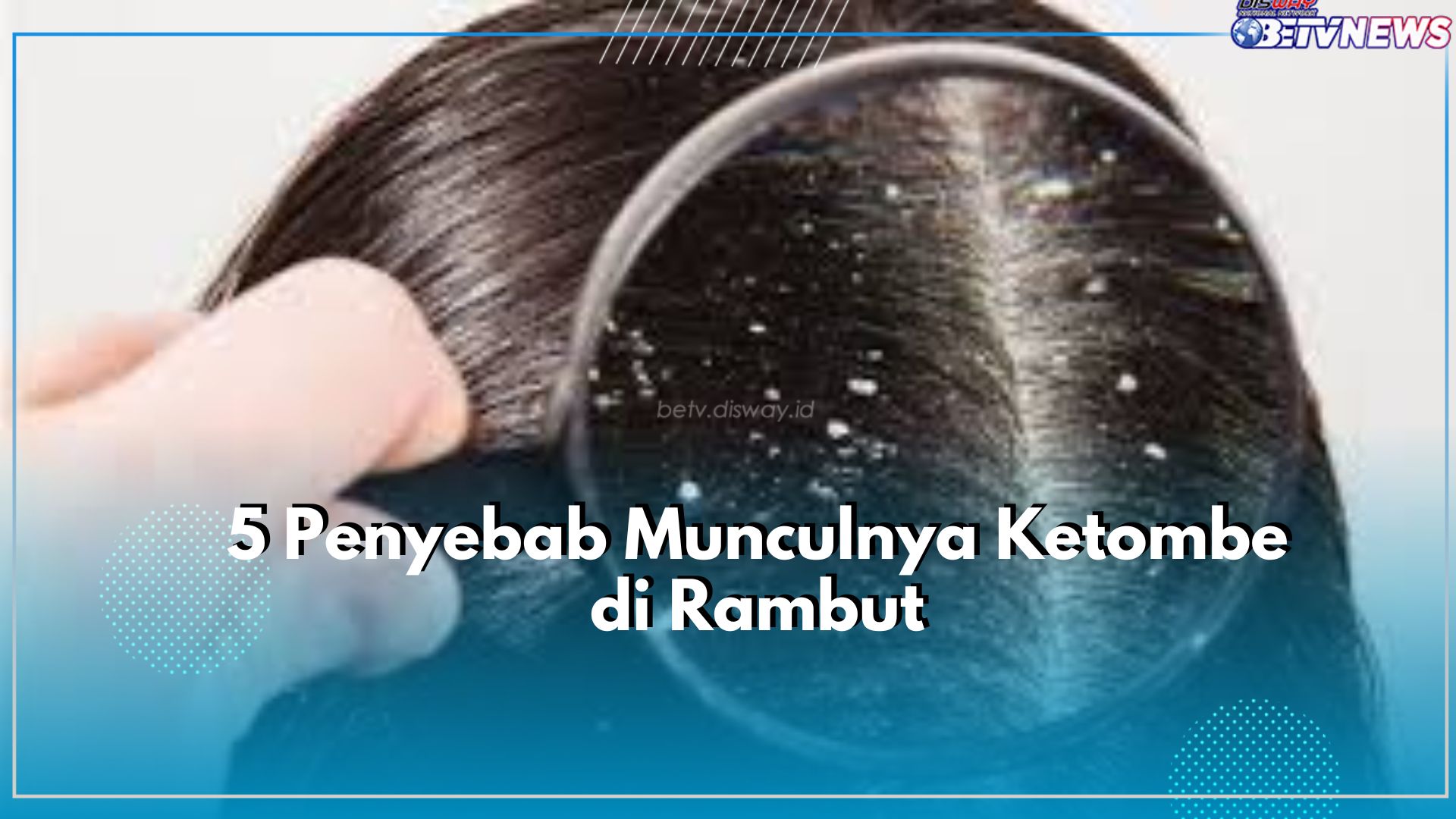 Wajib Tahu! Ini Dia yang Jadi Penyebab Datangnya Ketombe di Rambut