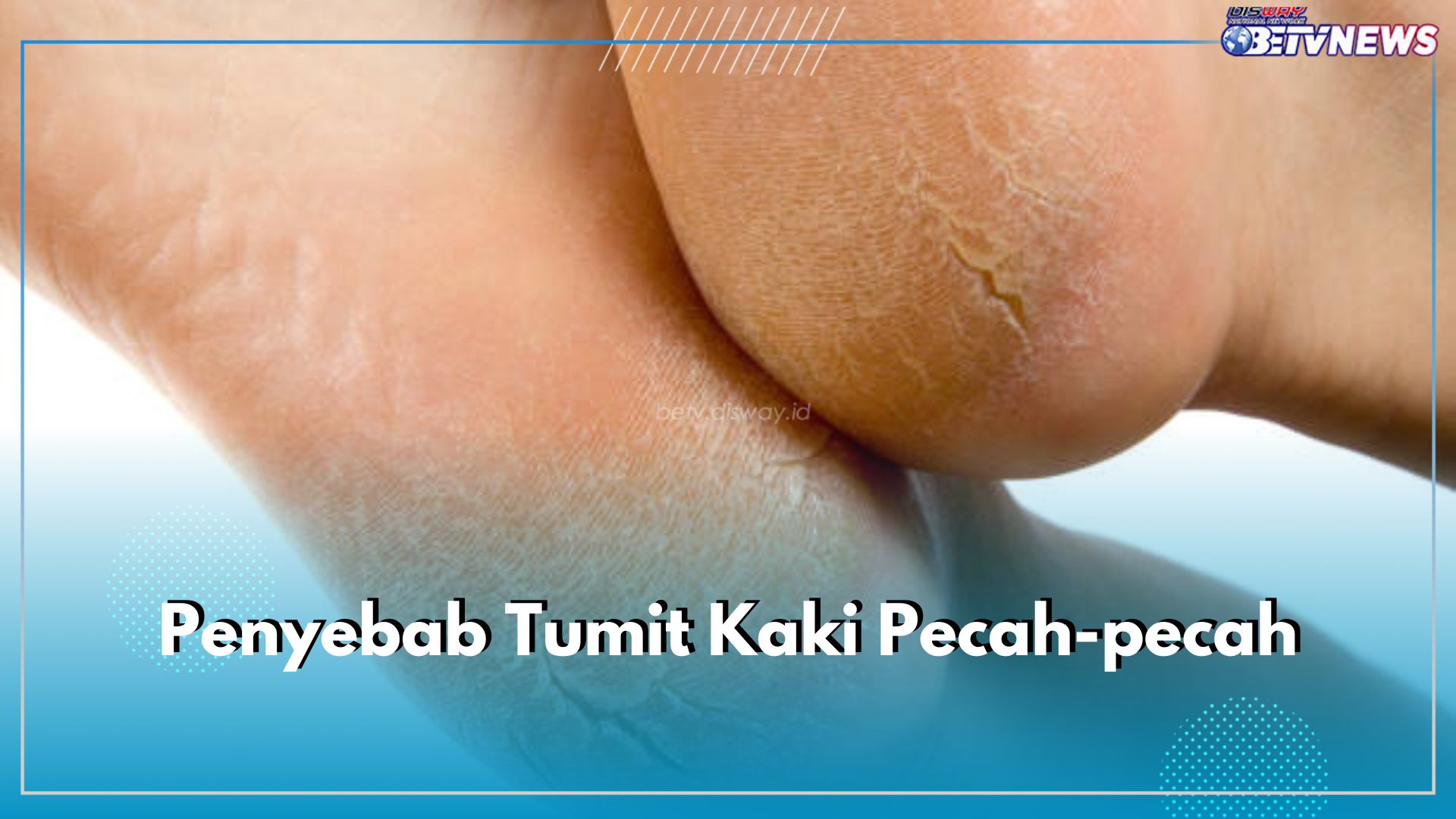 5 Penyebab Tumit Kaki Pecah-pecah, Salah Satunya Tekanan Berlebihan