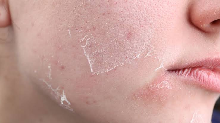 Ini Dia 5 Hal yang Harus Dilakukan untuk Mengatasi Kulit Kering di Wajah, Gunakan Eksfoliasi hingga Pelembab