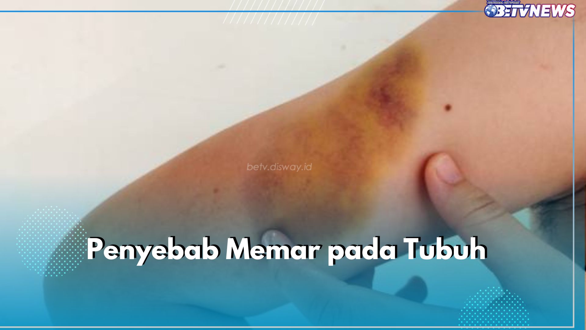 6 Penyebab Memar pada Tubuh yang Perlu Kamu Ketahui, Cedera Ringan hingga Pembekuan Darah