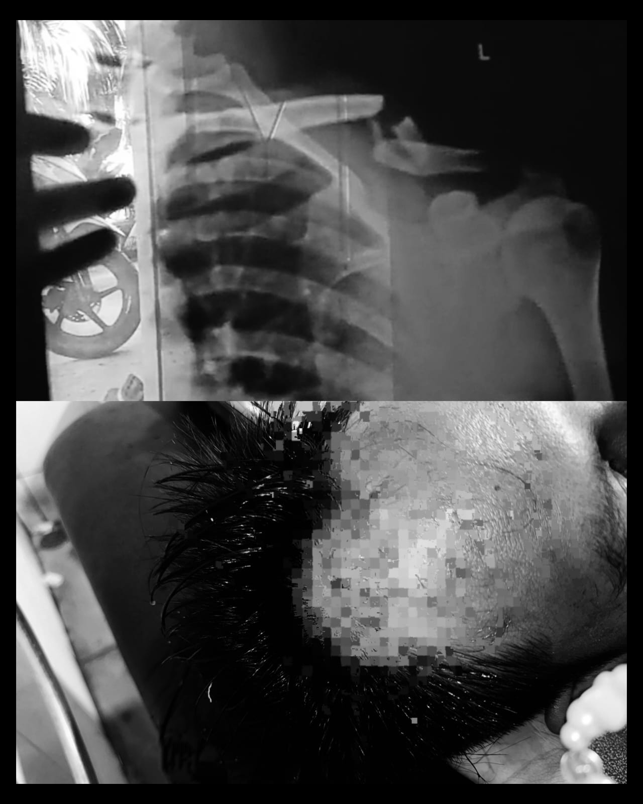 Warga Betungan Alami Patah Tulang dan Luka-luka, Akibat Diserang 10 Orang Tidak Dikenal