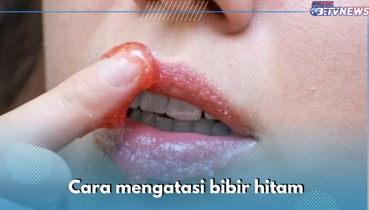 7 Cara Mengatasi Bibir Hitam yang Mudah Dilakukan, Salah Satunya Eksfoliasi 