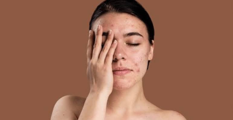 Terapkan Rahasia Ini, 11 Cara Jitu Memperbaiki Skin Barrier Rusak, Mudah Hanya Perlu Konsisten