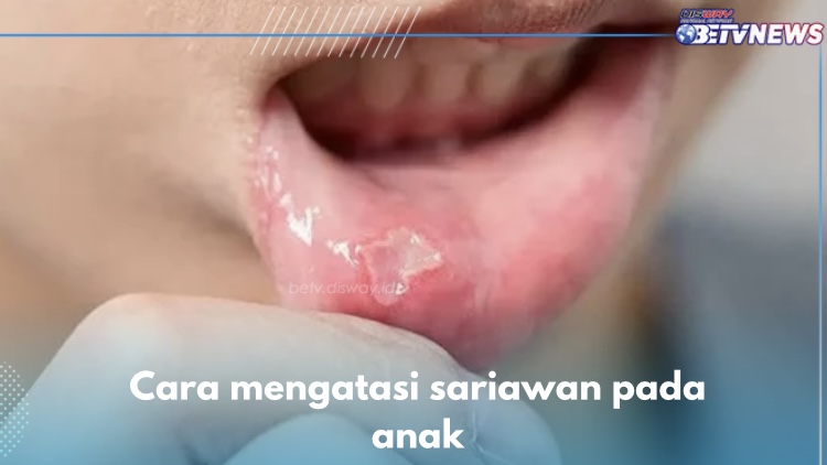 8 Cara Mengatasi Sariawan pada Anak, Kompres Dingin Salah Satunya