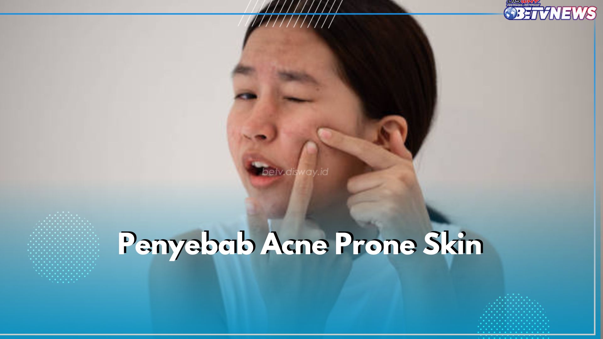 6 Penyebab Acne Prone Skin yang Perlu Kamu Ketahui, Salah Satunya Kebiasaan Sentuh Wajah