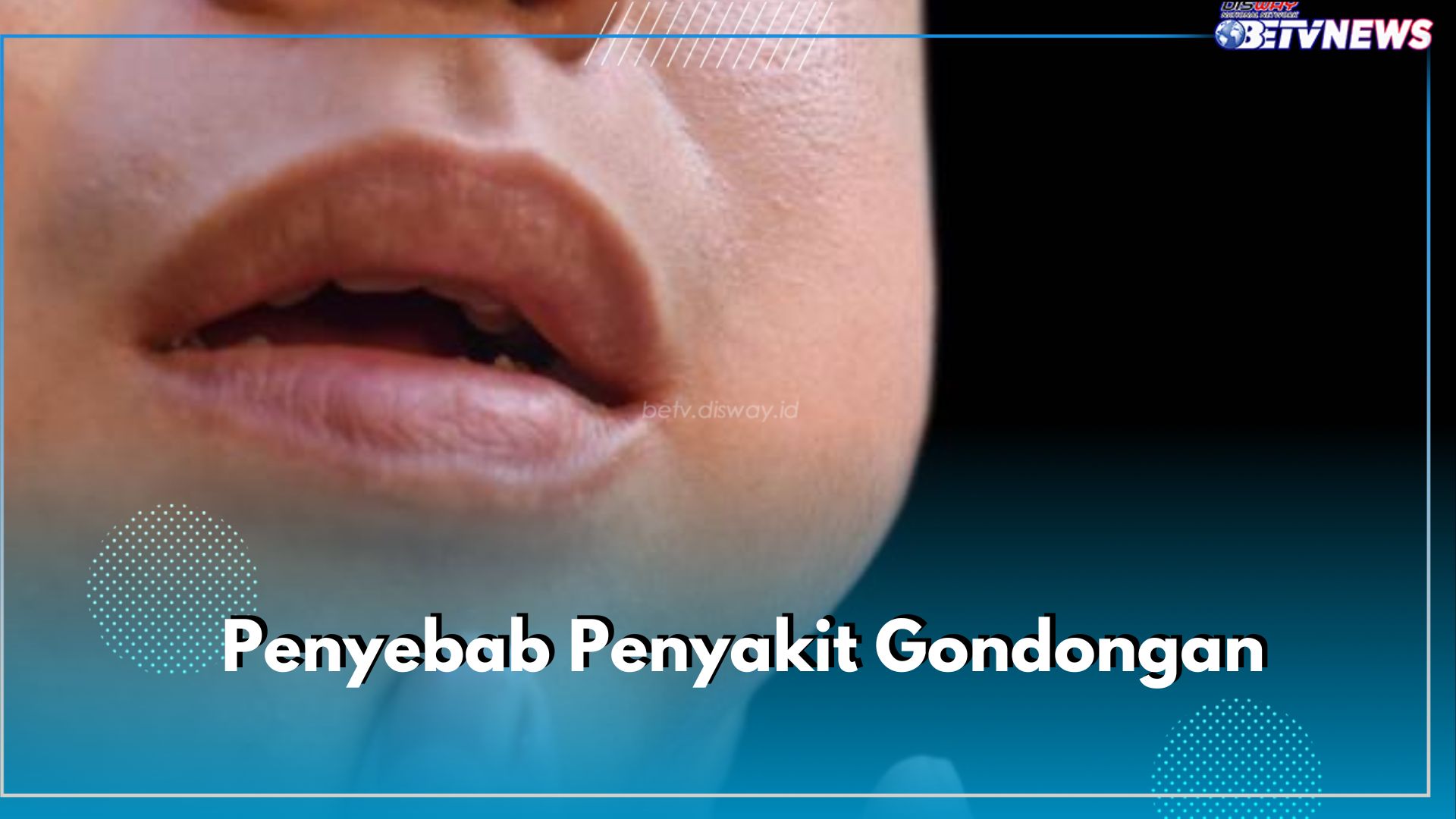 Jadi Penyakit Menular, Ketahui 6 Penyebab Penyakit Gondongan Ini untuk Menghindarinya