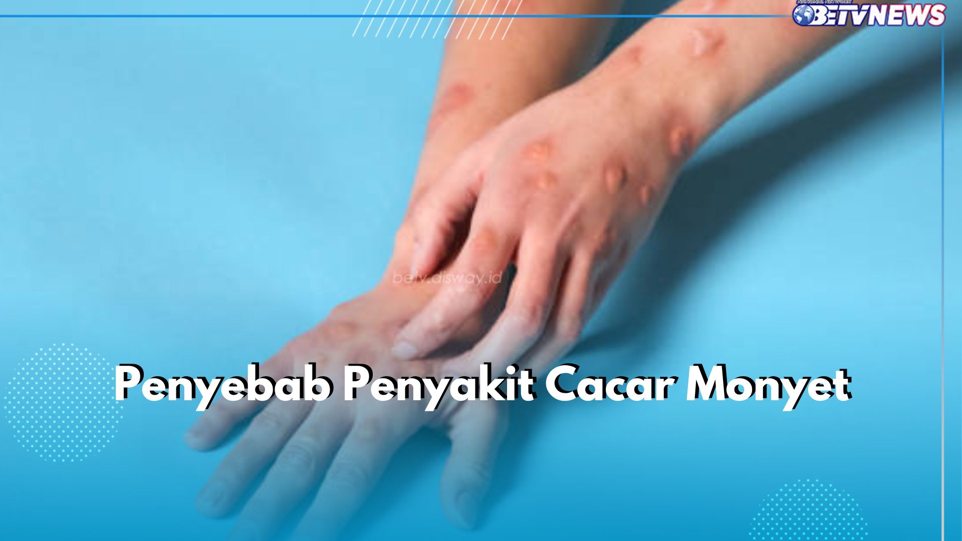 Waspada! Ini 5 Penyebab Penyakit Cacar Monyet yang Perlu Kamu Ketahui, Salah Satunya Kontak Cairan Tubuh