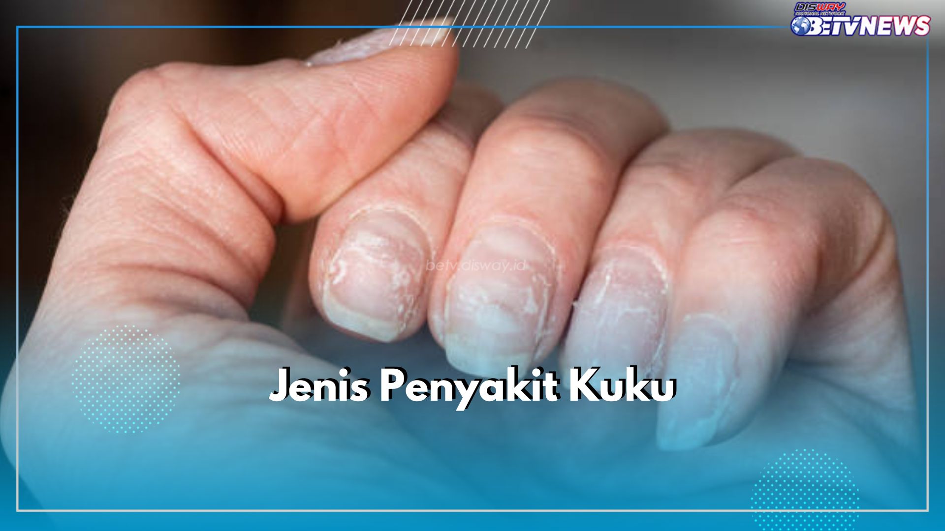 5 Jenis Penyakit Kuku Ini Tak Boleh Disepelekan, Ada Nail Pitting hingga Kuku Sendok