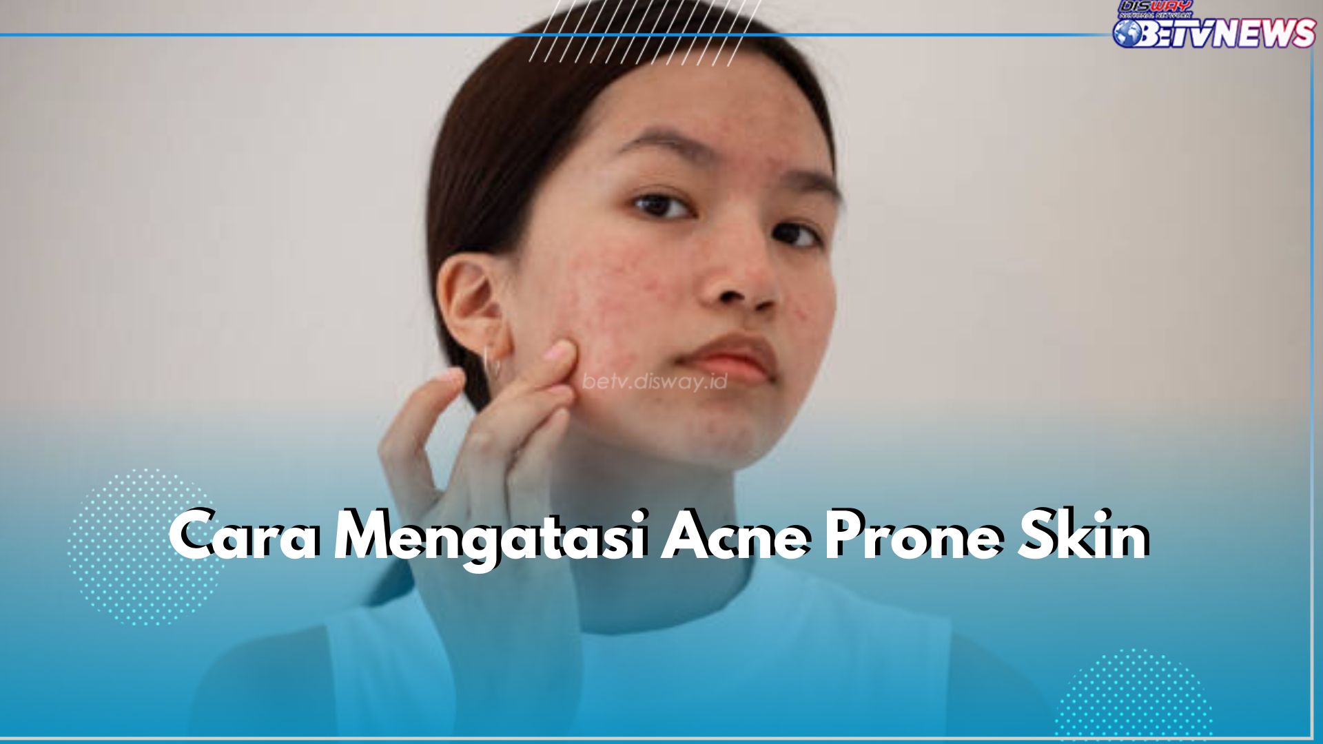 Acne Prone Skin Rentan Berjerawat, Ini 6 Cara Tepat Mengatasinya