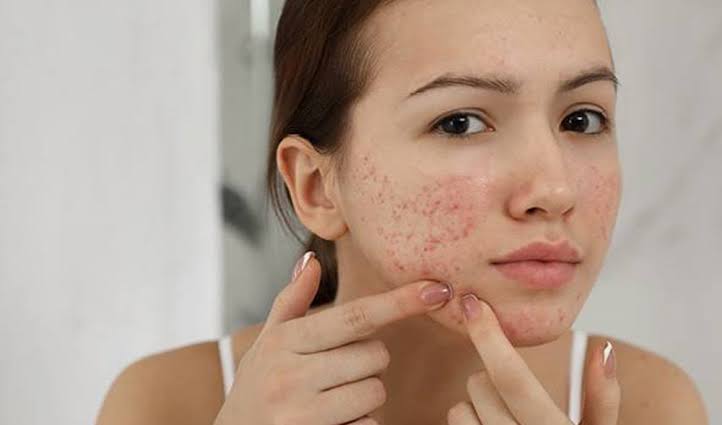Penting! 6 Cara Mengatasi Acne Prone Skin, Buat Wajah Bebas dari Jerawat