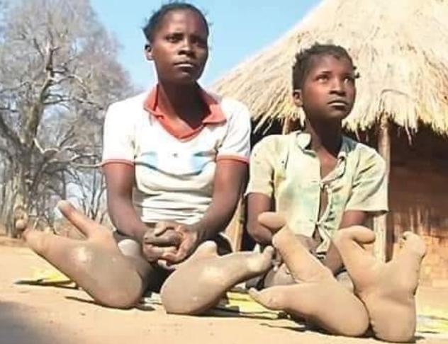 Mereka Bangga! Suku Vadoma di Zimbabwe Ini Unik, Punya Kaki Mirip Burung Unta