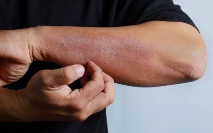 Kulit Kering Bisa Diatasi dengan Makanan Tinggi Kandungan Vitamin, Cek Daftarnya Disini!