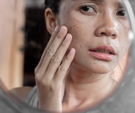 Perlu Tahu! Penyebab Flek Hitam di Wajah, Bukan Cuma karena Sinar Matahari