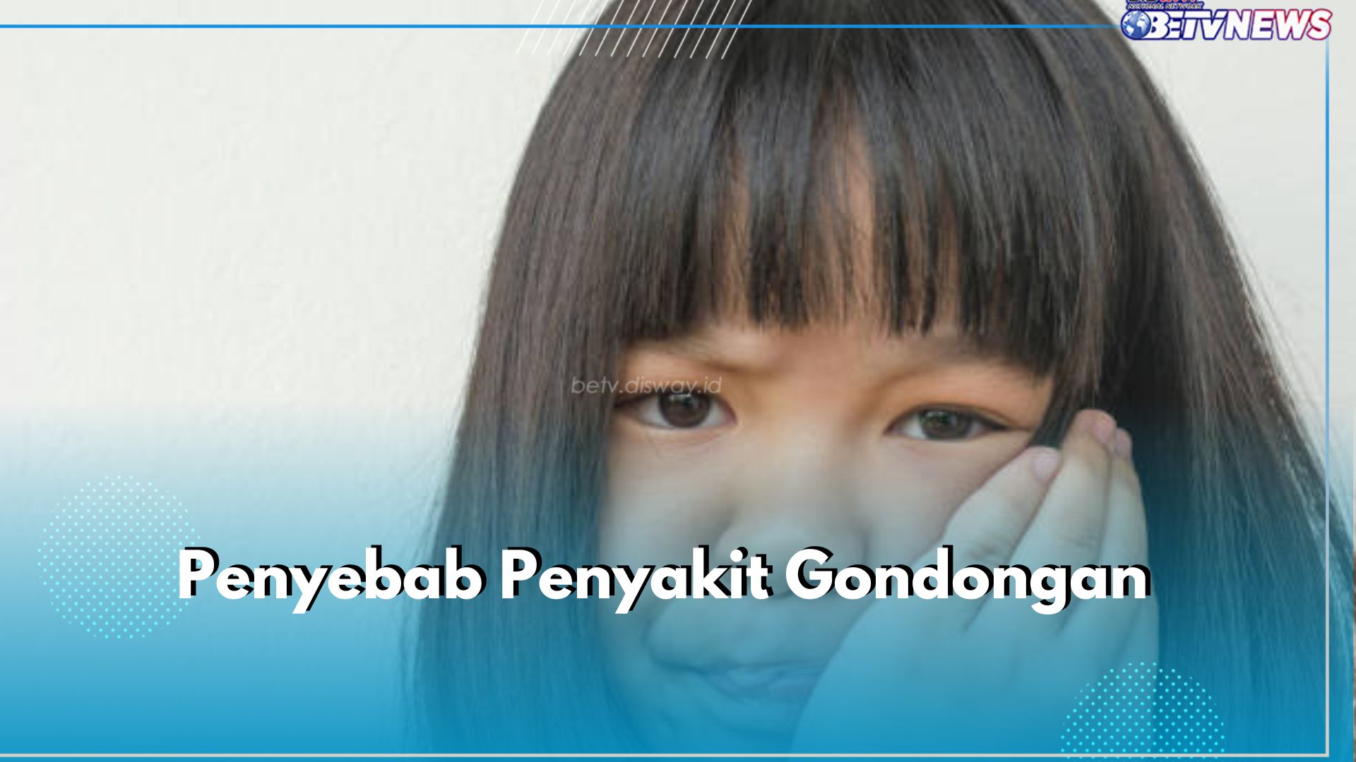 Penting! Ketahui 6 Penyebab Penyakit Gondongan Ini dan Hindari Agar Tak Terjangkit