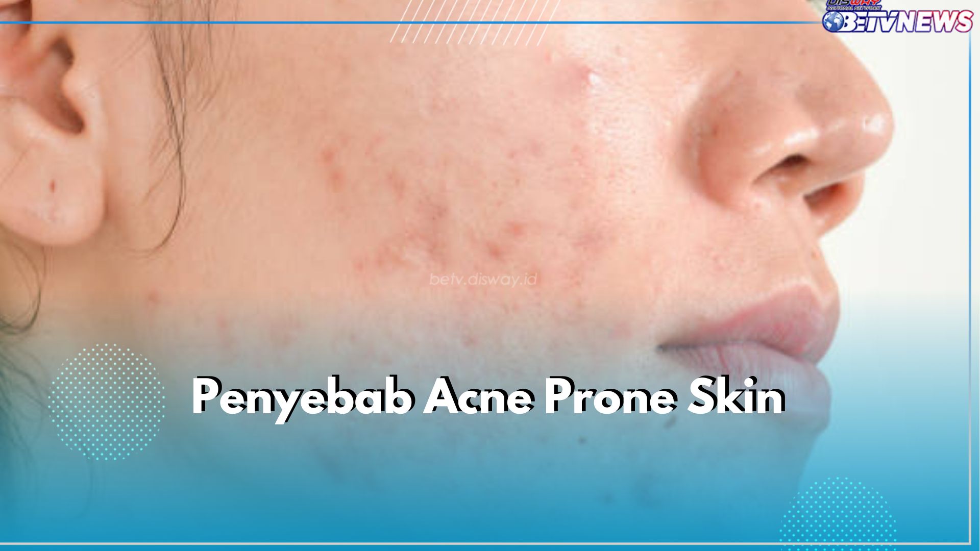 Ketahui 6 Penyebab Acne Prone Skin pada Wajah Ini untuk Perawatan yang Tepat, Apa Saja?