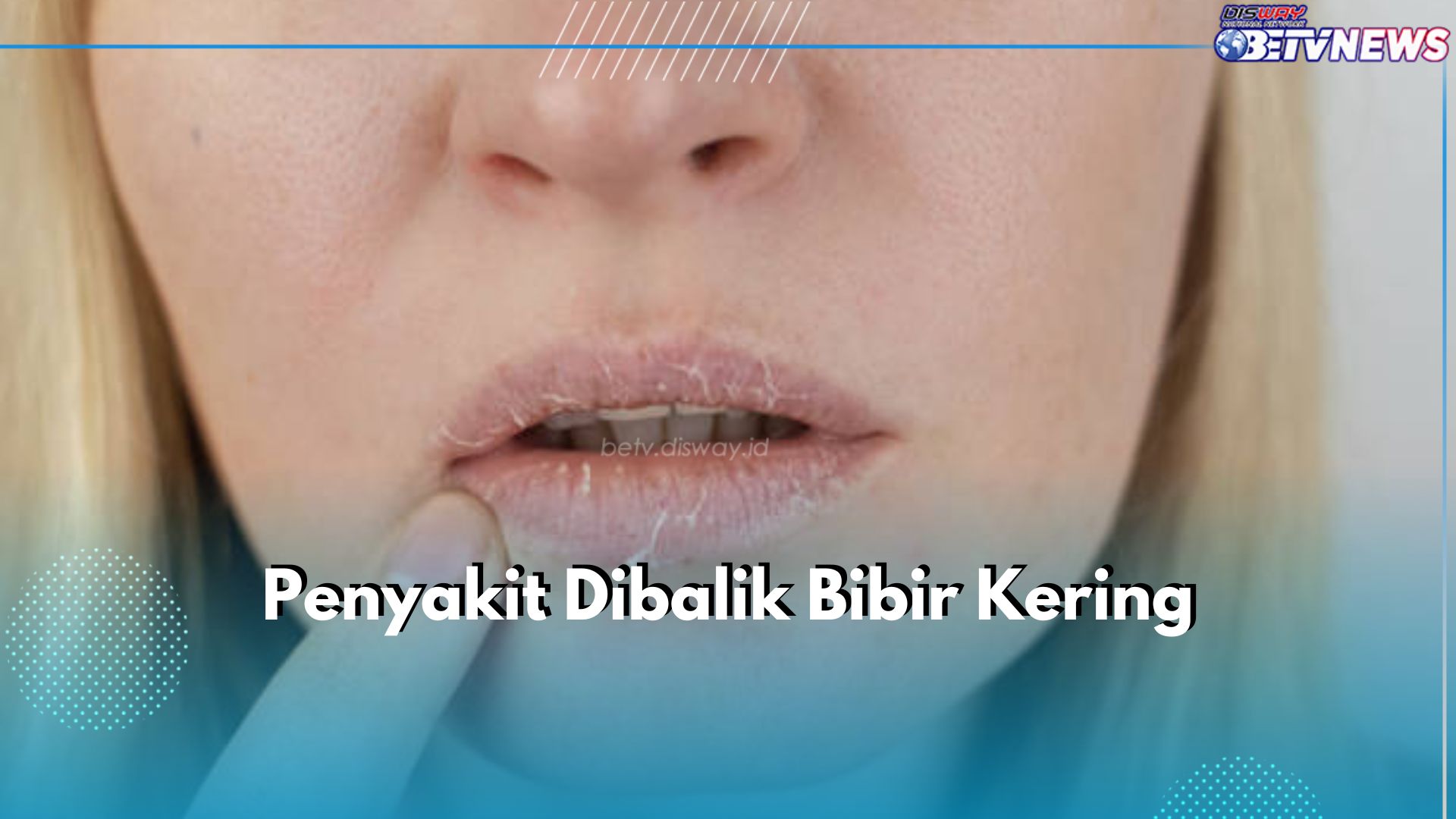 Waspada! Bibir Kering Bisa Jadi Tanda 5 Penyakit Ini, Salah Satunya Infeksi Jamur