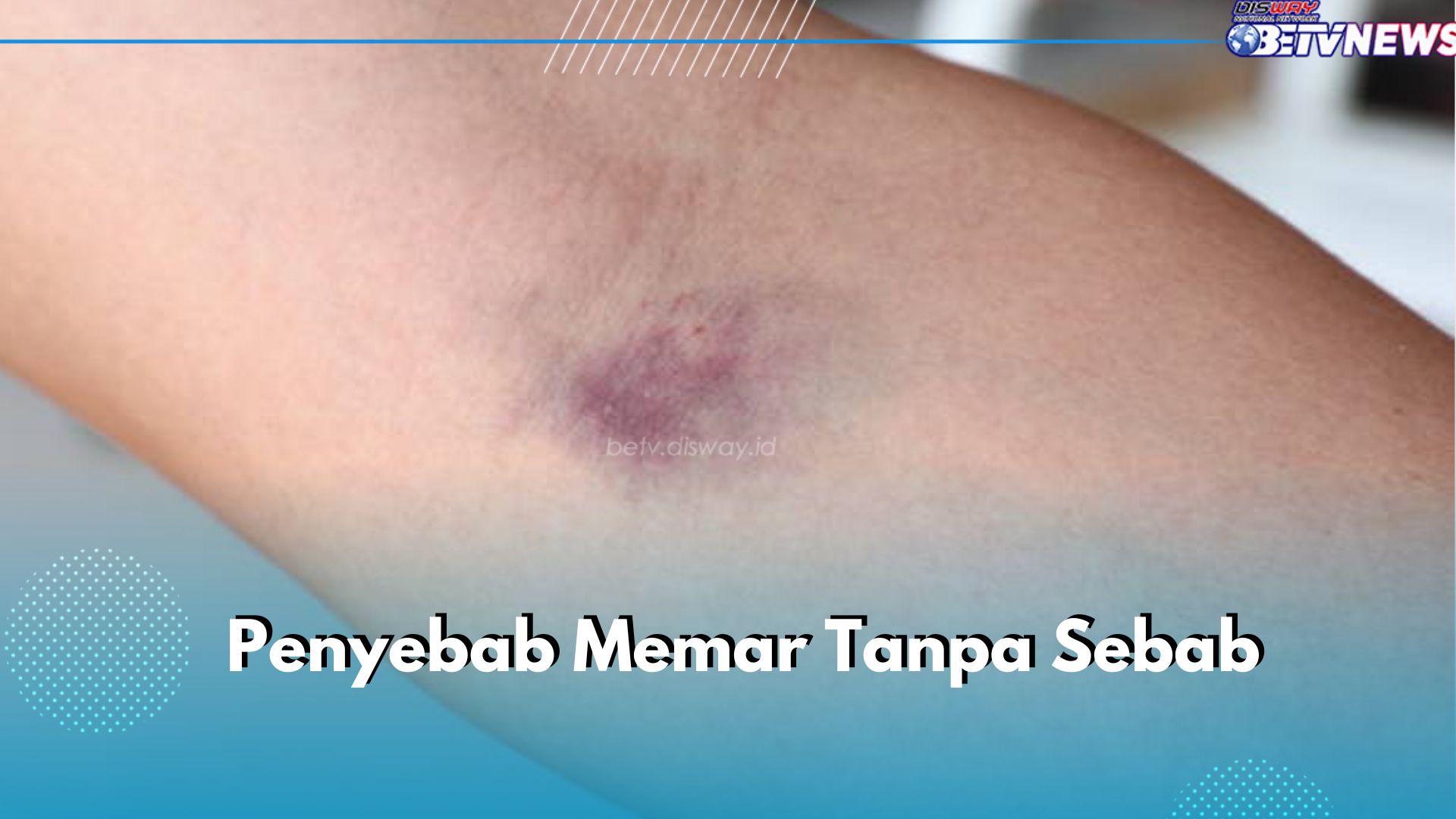 6 Penyebab Memar Tanpa Sebab di Tubuh, Salah Satunya Penyakit Autoimun