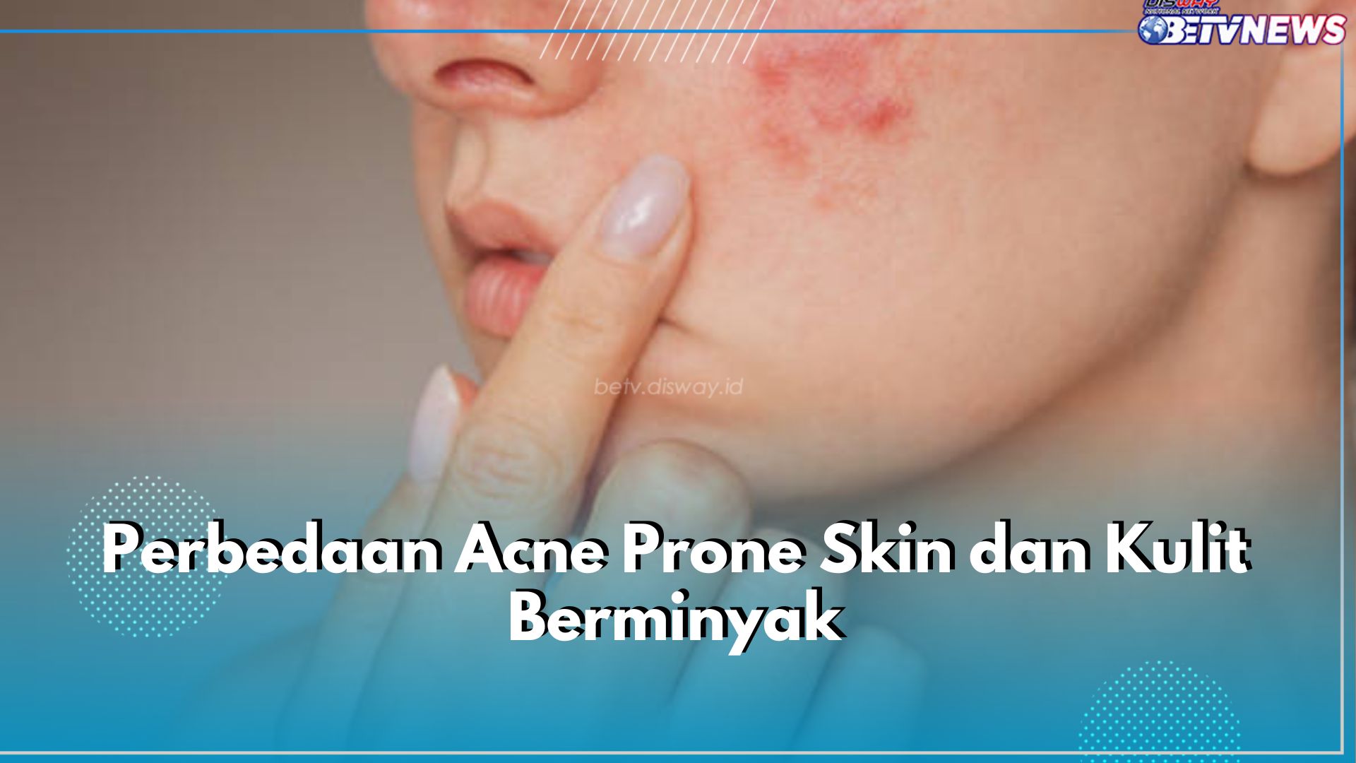 Ini 6 Perbedaan Acne Prone Skin dan Kulit Berminyak, Punya Respon Berbeda pada Produk Skincare