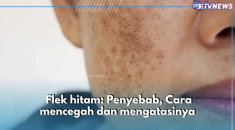 Flek Hitam di Wajah: Penyebab, Cara Mencegah dan Mengatasinya