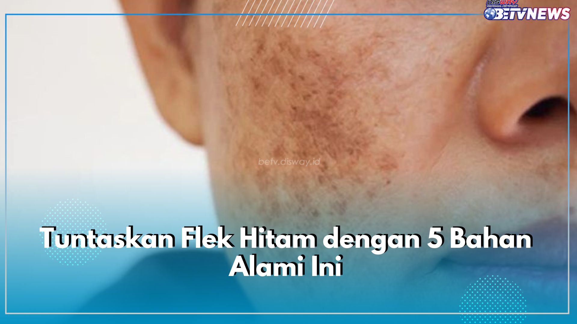 Tuntaskan Flek Hitam dengan 5 Bahan Alami Ini, Cara Efektif Hilangkan Bintik Hitam di Wajah