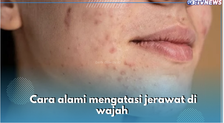 Ini 8 Cara Alami Mengatasi Jerawat di Wajah, Rutin Pakai Masker Alpukat Salah Satunya