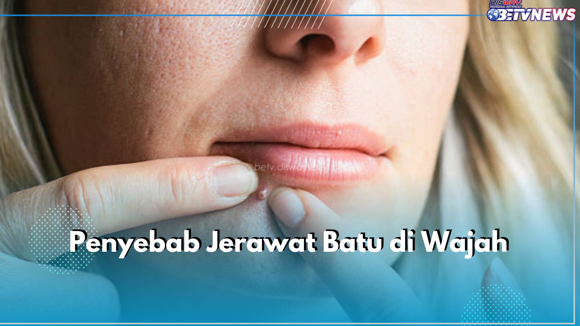 5 Penyebab Jerawat Batu di Wajah, Perubahan Hormon hingga Stres