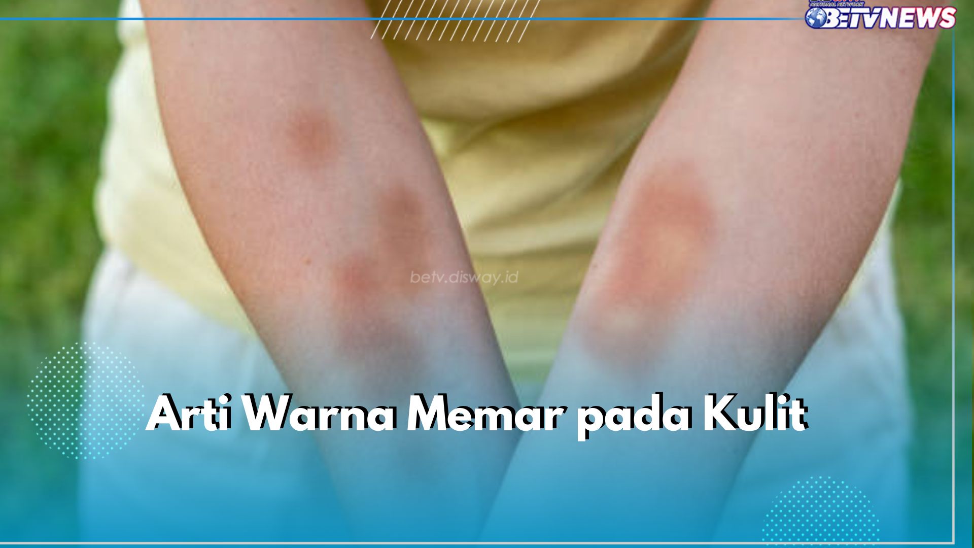 Ketahui Arti Warna Memar pada Tubuh Ini, Mulai Warna Merah hingga Keunguan 